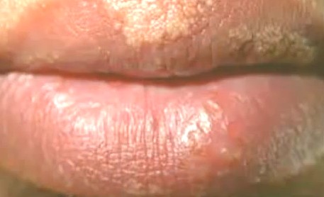 Fordyce Spots Lips